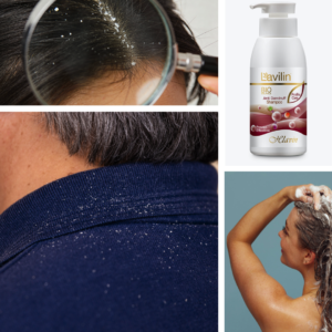 Dandruff and anti dandruff shampoo of Hlavin