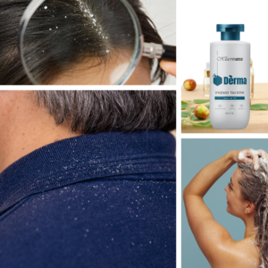 קשקשים ושמפו נגד קשקשים